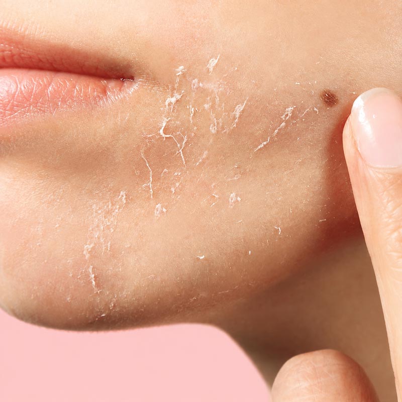 Psoriazis & Dermatită